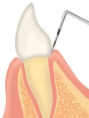 歯周ポケットの検査