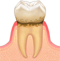 歯肉炎（LEVEL 1）