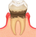 軽度歯周炎（LEVEL 2）