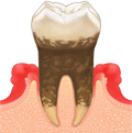中度歯周炎（LEVEL 3）